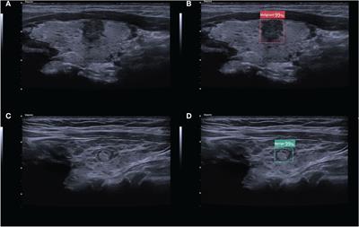 Investigating the diagnostic efficiency of a computer-aided diagnosis system for thyroid nodules in the context of Hashimoto’s thyroiditis